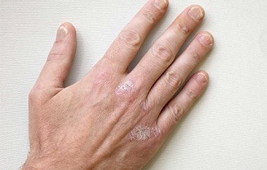 шелушение и дерматит на коже руки