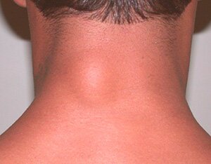 проявление липоматоза на шее